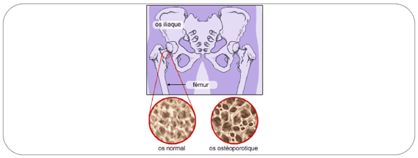 osteoporose03